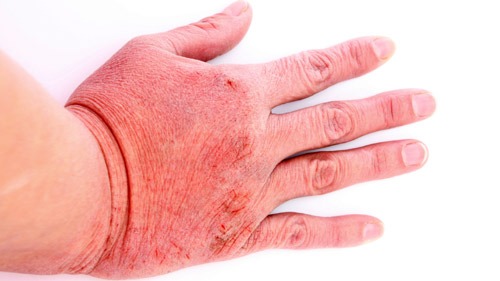 Truths About Atopic and Allergic Dermatitis - Default to Nature